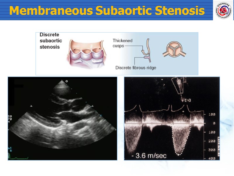 Membraneous Subaortic Stenosis